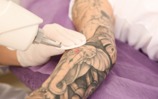 Tattoo-Entfernung: Methoden, Vor- und Nachteile