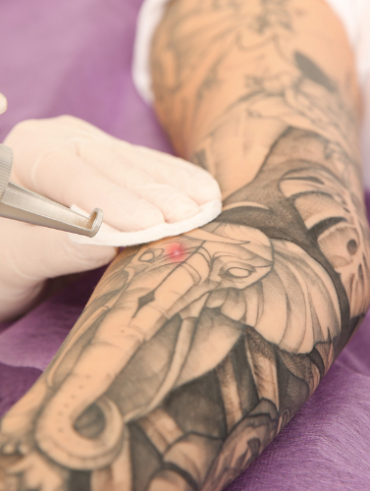 Tattoo-Entfernung: Methoden, Vor- und Nachteile
