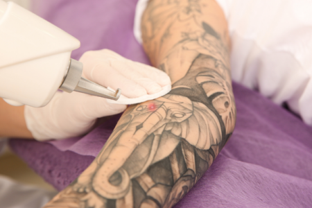 Tattoo-Entfernung: Methoden, Vor- und Nachteile