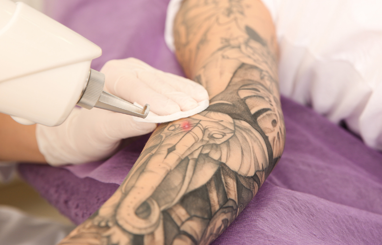 Tattoo-Entfernung: Methoden, Vor- und Nachteile